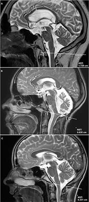 Nuchal Skinfold Thickness in Pediatric Brain Tumor Patients